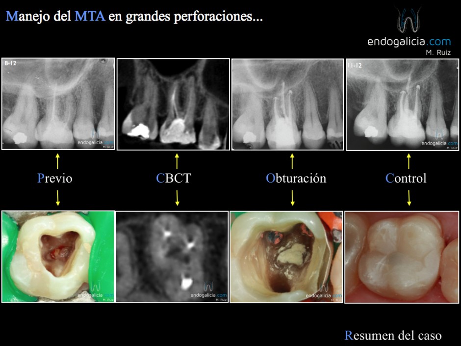 Manejo Del MTA En Grandes Perforaciones. Resumen AEDE Cadiz 2012 ...