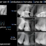 rx caso endogalicia molar 4 conductos